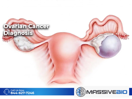 diagnosis of ovarian cancer