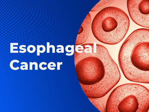 Esophageal Cancer Blog