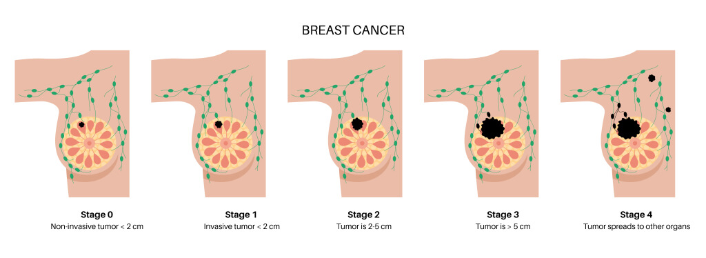 Where Are Breast Cancer Lumps Usually Found?