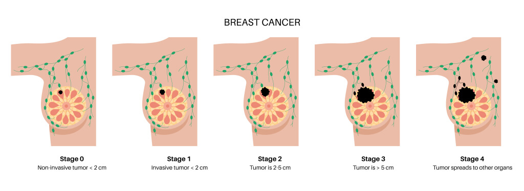 What do cancerous breast lumps feel like?