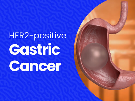 Gastric Cancer Her2 Positive