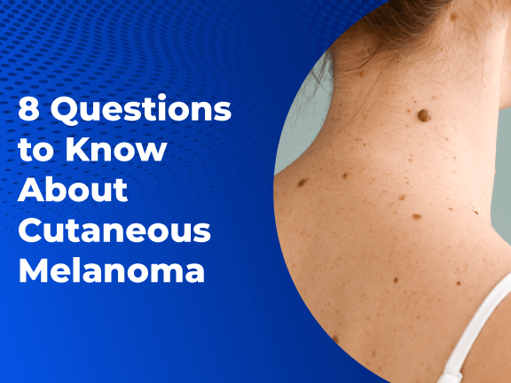 8 Questions to Know About Cutaneous Melanoma