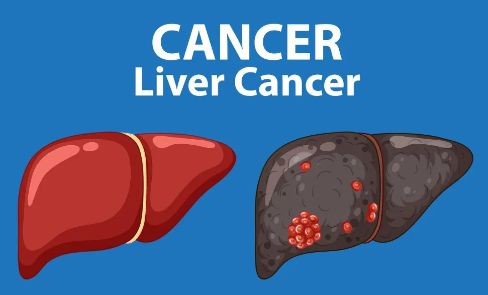 Liver cancer treatment 02
